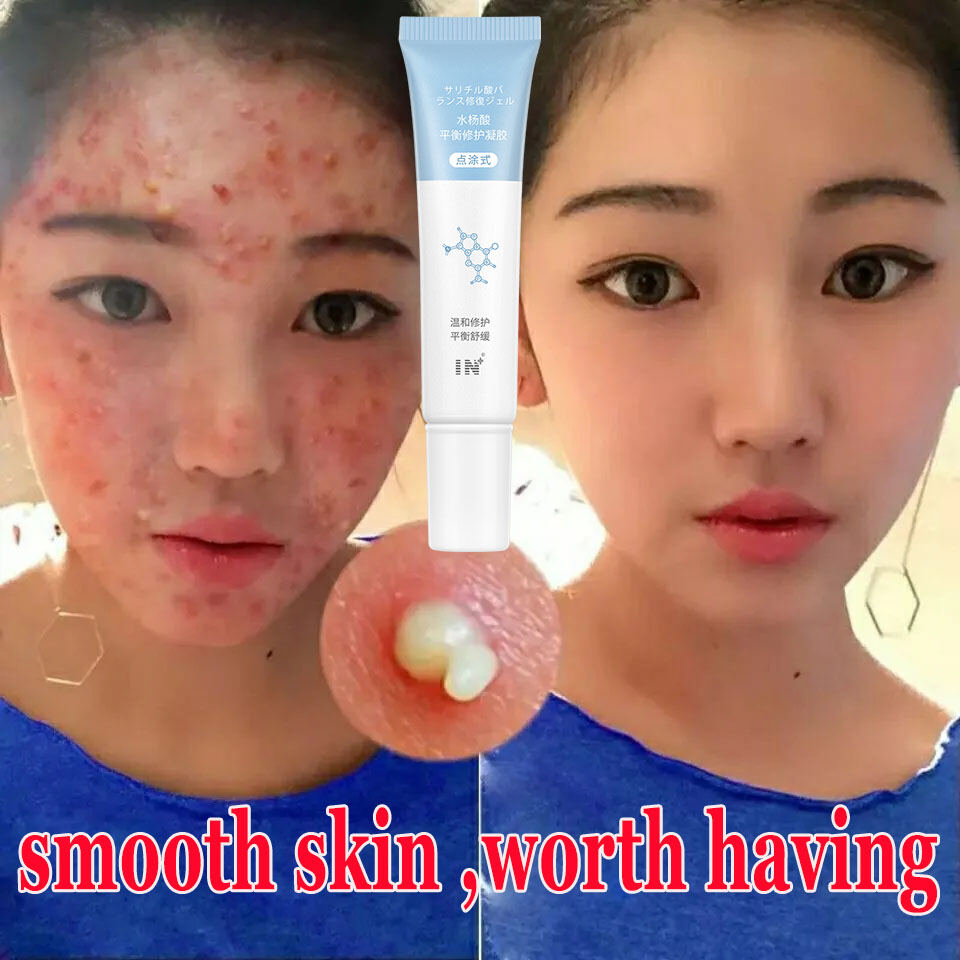 IN Salicylic acid Repair gel 水杨酸 Get rid of redness and acne Lighten acne marks beauty Shrink pores 收缩毛孔 Acne Solution Set Acne Treatment Serum Cream Spots Pimple Removal Essence Anti Acne Scar Skin C
