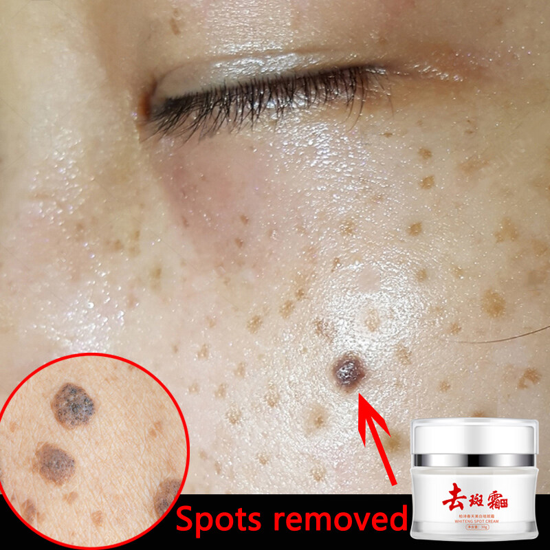 IN Official Store Freckle cream Powerful Whitening Removes mole freckles and black spots Facial Skin Care serum spot treatment cream 30g